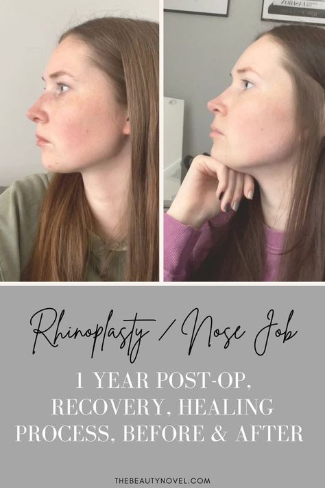 I decided to take you with me on my rhinoplasty journey and tell you everything you need to know including Rhinoplasty Cost, Rhinoplasty Swelling, Nose Job Recovery Tips, Wearing glasses after a nose job, Rhinoplasty Before & After and more. Nose Job Recovery, Rhinoplasty Recovery, Rhinoplasty Nose Jobs, Rhinoplasty Before And After, Facial Fillers, Luxury Designer Bags, No Experience Jobs, Love Luxury, Nose Shapes