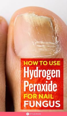 Nail Fungus Remedy, Fungal Nail, Tongue Health, Foot Soak, Toenail Fungus, Fungal Infection, Nail Fungus, Hydrogen Peroxide, Nail Health