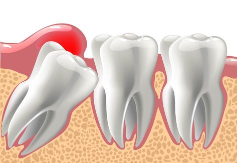 Wisdom Teeth Food, Wisdom Teeth Pain Relief, Wisdom Teeth Recovery, Impacted Wisdom Teeth, Teeth Problems, Wisdom Teeth Pain, Tooth Pain Relief, Wisdom Teeth Funny, Teeth Surgery