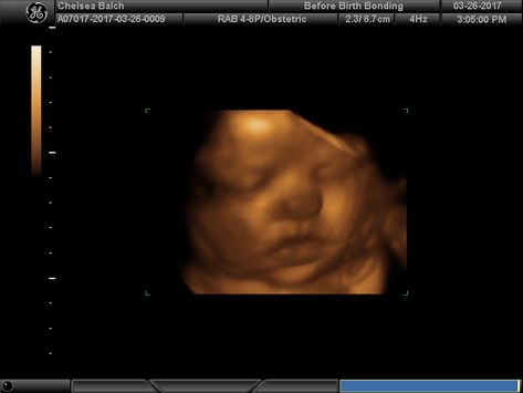 3D ultrasound 😍 3d Ultrasound Pictures, Picture Template, 3d Ultrasound, Ultrasound Pictures, Picture Templates, Girls Cartoon, Girls Cartoon Art, Ultrasound, Girl Cartoon