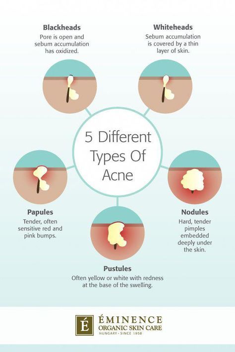 From #blackheads to #pustules learn all about 5 different types of #acne and the best methods to treat them. ---- #EminenceOrganics #cleanbeauty #clearskin #acnetreatment #skin #skincare #esthetics #natural Types Of Acne And How To Treat, Skincare Esthetics, Cosmetology Aesthetic, Face Remedies, Face Gym, Types Of Facials, Eminence Organic Skin Care, Types Of Acne, Natural Cold Remedies