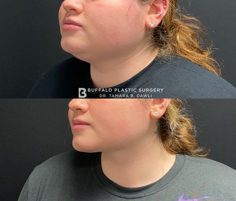 Facial Lipo Before And After, Neck Lipo Before And After, Chin Lipo Before And After, Chin Fillers Before After, Plastic Aesthetic, Lipo Before And After, Fat Transfer, Full Lips, Buffalo New York