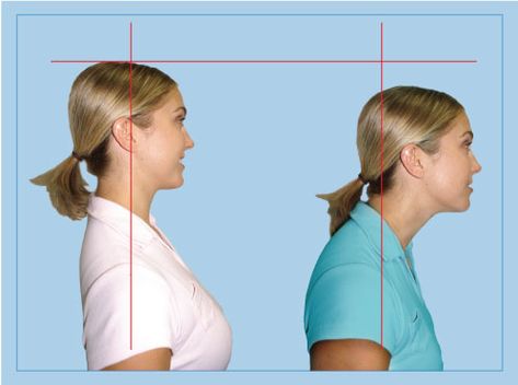 Forward Head Posture Exercises, Posture Fix, Neck And Shoulder Muscles, Forward Head Posture, Pinched Nerve, Neck Exercises, Posture Exercises, Upper Back Pain, Neck And Shoulder Pain