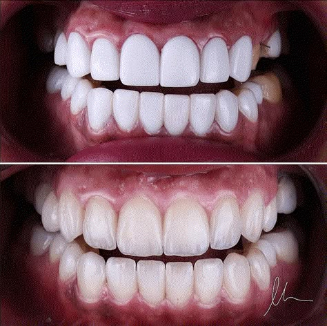 Your teeth should look natural, not fake!  #veneers #dental #teeth Natural Looking Veneers Teeth, Teeth Fangs Natural, Teeth Veneers, Whiten Your Teeth At Home, Whiten Teeth At Home, Dental Ceramics, Teeth Whitening At Home, New Teeth, Dental Aesthetics