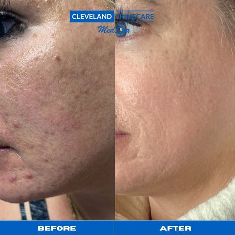 Microneedling + Peels = Perfection This client came in with complaints of the texture and discoloration she was experiencing. After listening to her desired outcome, we decided that a series of 3 microneedling sessions and chemical peels would work best. The first picture is before any treatments and the after is upon completing all 3 microneedling sessions and chemical peels. We love the results and so does she! #ClevelandMedspa #ClevelandPrimecareMedspa #ClevelandBotox #Botox #Cleveland... Biorepeel Before And After, Microneedling Before And After, Chemical Peels, Chemical Peel, Med Spa, Laser Hair Removal, A Series, One Pic, Cleveland