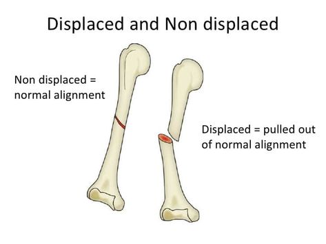 Children are being forced to stay at homes due to the pandemic situation we ve got at the current mo ... Open Fracture, Fracture Healing, Bone Healing, Hyperactive Kids, Bone Grafting, Bone Fracture, Musculoskeletal System, Icd 10, Human Bones