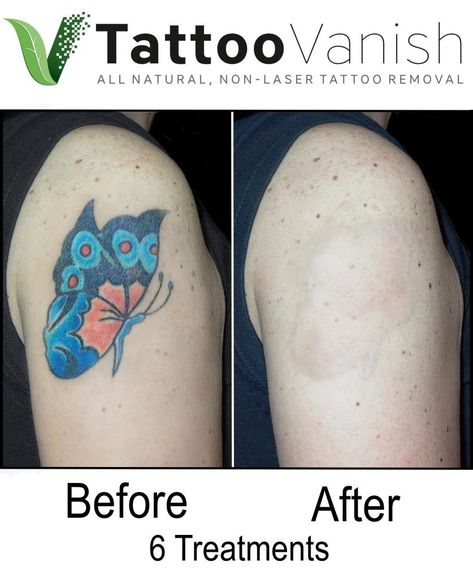 Before and After Tattoo Removal - Get the Best Results the All-Natural Way | Tattoo Vanish Tattoo Cover Up Ideas Before And After, Remove Tattoo At Home, Tattoo Rework Before And After, Tattoo Fix Before And After, Tattoo Touch Up Before And After, Laser Tattoo Removal Before And After, Tattoo Removal Before And After, Tattoos After Pregnancy, Before And After Tattoo