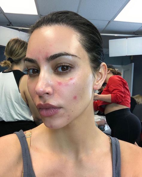 Girl With Acne, Kardashian House, Acne Beauty, Autoimmune Disorders, Unedited Photos, Real Skin, Robert Kardashian, Hair Massage, The Simple Life