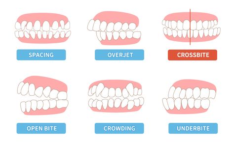 When teeth align correctly, upper teeth naturally fit on the outside of lower teeth. Chewing and biting are painless and easy with correct alignment. Poorly aligned bites, on the other hand, can lead to problems like cracked or broken teeth and/or worn enamel due to the repeated irregular contact between upper and lower teeth. Rotten Teeth, Cracked Tooth, Broken Teeth, Teeth Alignment, Clear Braces, Crooked Teeth, Tooth Removal, How To Prevent Cavities, Root Canal