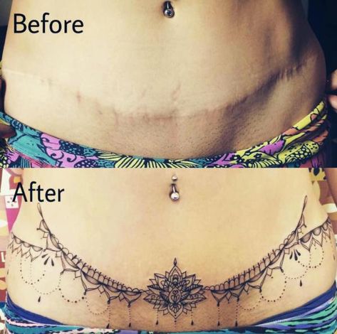 Tummy Tuck Tattoo: What You Need to Know | Art and Design Lower Stomach Tattoos For Women, Lower Belly Tattoos, Abdomen Tattoo, Tummy Tattoo, Henne Tattoo, Stomach Tattoos Women, Scar Cover Up, Tattoos To Cover Scars, Tattoos Infinity