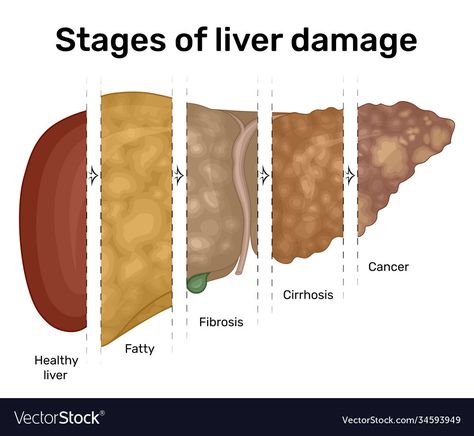 Stage 3 Liver Fibrosis, The Liver, Cirrhotic Liver, Liver Illustration, Liver Anatomy, Liver Detox Diet, Healthy Liver Diet, Liver Diet, Lung Disease