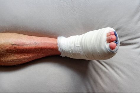 Many wonder how to reduce swelling after bunion surgery because it is very common. Learn how to deal with this issue and improve your recovery process. Bunionette Surgery, Bunionectomy Recovery, Ankle Pumps, Ankle Surgery, Happy Mommy, Reduce Swelling, Surgery Recovery, Leg Muscles, Calf Muscles