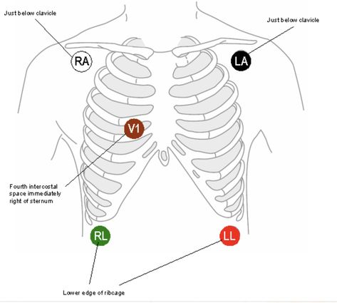 Smoke (Black) over fire(Red) clouds(White)over grass (green) Chocolate (Brown) in the middle close to the heart ❤️🧡💛💚💙💜🖤 Telemetry Lead Placement, 5 Lead Ekg Placement, Ecg Placement, Ekg Placement, Lead Placement, Nursing School Prep, Nursing Labs, Nursing School Scholarships, Medical Assistant Student