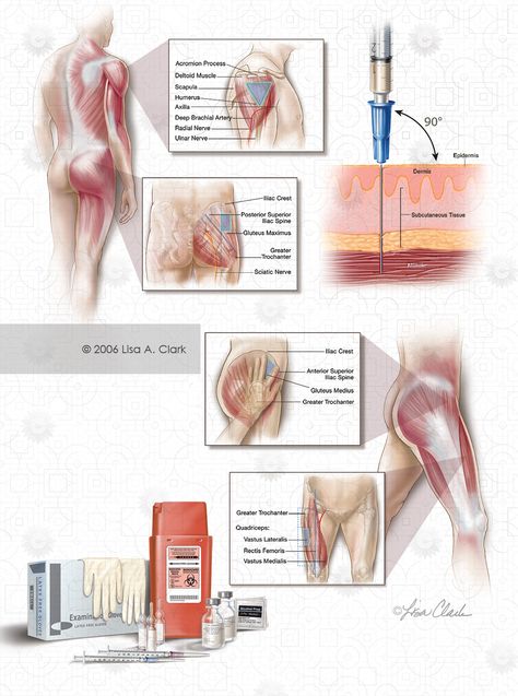 Intramuscular Injection Sites Image Im Injection Sites Nursing, Injection Sites Nursing, Intramuscular Injection Sites, Im Injection Sites, Iv Bar, Medical Assistant Certification, Injection Sites, Im Injection, Triage Nursing