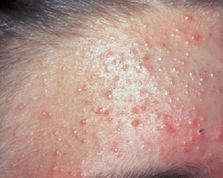 Types Of Acne And How To Treat, Acne Photos, Nodule Acne, Benzoyl Peroxide Wash, Feed Photos, Acne Vulgaris, Acne Face Wash, Types Of Acne, Clearer Skin