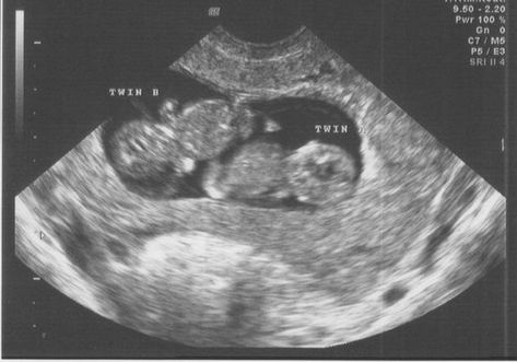 Boy Ultrasound, Twins Ultrasound, Twin Baby Boys, Baby Ultrasound, Ultrasound Pictures, Twin Pregnancy, Foto Baby, Asian Babies, Twin Boys