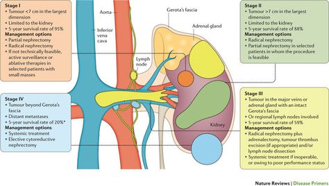 Renal Cell Carcinoma, Creatinine Levels, Pig Pattern, Kidney Stone, Human Body Systems, Adrenal Glands, Health Planner, Bacterial Infection, Body Systems