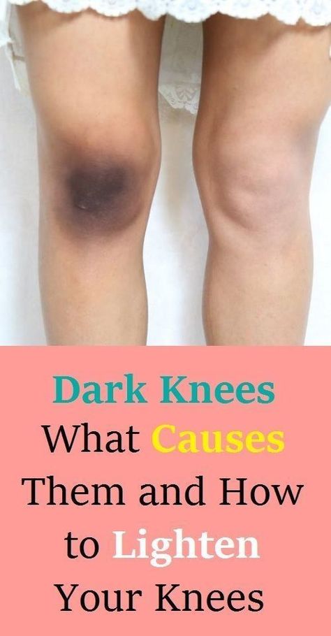 Dark Knees: What Causes Them and How to Lighten Your Knees How To Lighten Knees, Dark Neck Remedies, Dry Skin Home Remedies, Dark Patches On Skin, Dark Spots On Legs, Dark Knees, Dark Elbows, Lighten Skin Tone, Constant Headaches