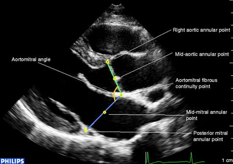 Echo Tech Cardiac, Cardiovascular Anatomy, Echo Ultrasound, Heart Ultrasound, Diagnostic Medical Sonography Student, Ultrasound School, Cardiac Sonography, Sonography Student, Ultrasound Sonography