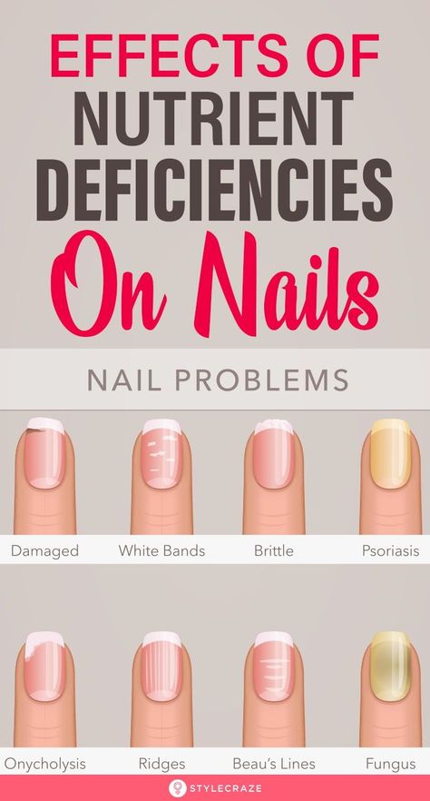 Effects Of Nutrient Deficiencies On Nails: Their shape, texture, color, growth rate – everything is a sign that your body is screaming for nutrients. Most of the changes in your nails and skin occur due to vitamin and nutrient deficiency. Here’s a list of symptoms that you may notice in your nails and what they mean for your health. #Nails #NailCare #NutritionDeficiency #NailCareTips Nail Health Signs, Nail Conditions, Nail Problems, Vitamin Deficiency, Health Signs, Magnesium Deficiency, Tongue Health, Nail Care Tips, Nutrient Deficiency