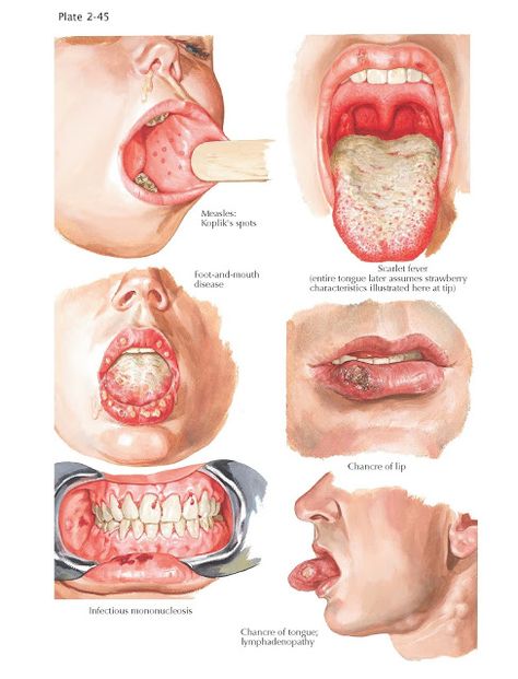 Oral Manifestations in Systemic Infections   Oral manifestations can be observed in almost every generalized systemic infectious disease.... Soft Palate, Basic Anatomy And Physiology, Pimples Remedies, Nursing School Survival, How To Prevent Cavities, Medical Anatomy, Healthy Smile, Healthy Teeth, Dental Health