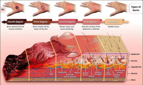 Burns Nursing, Burn Wound, Types Of Burns, How To Heal Burns, Nursing School Essential, Nursing School Motivation, Basic Anatomy And Physiology, Nursing Care Plan, Nursing Student Tips