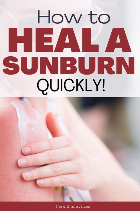 10 effective ways to heal a sunburn Coconut Oil For Sunburn, Best Remedy For Sunburn, Sunburn Cream, Best For Sunburn, Best Sunburn Relief, How To Help Sunburn, Home Remedies For Sunburn, Get Rid Of Sunburn, Severe Sunburn