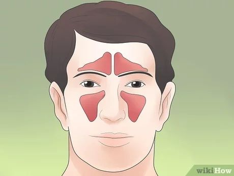 3 Ways to Stop Sinus Headaches - wikiHow Health Sinus Headache Remedies, Sinus Headache Relief, Getting Rid Of Headaches, Sinus Infection Remedies, Headache Relief Instant, Sinus Headache, Sinus Infection, Headache Relief, Headache