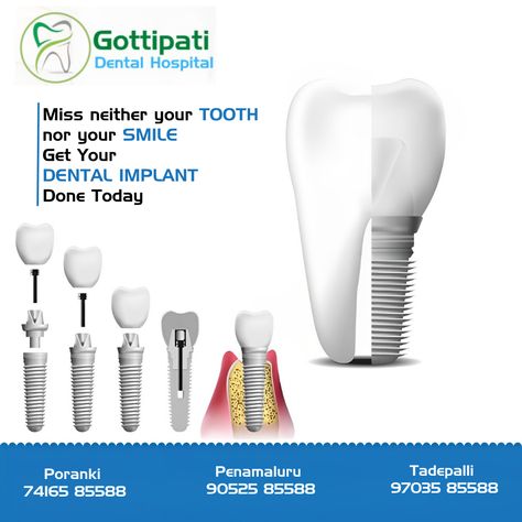 Get Your DENTAL IMPLANT Done Today For More Details Visit Our Gottipati Dental Hospital In Vijayawada #Dentalhospitalinvijayawada #Braces #Metalcrowns #Teethwhitening #Implants #Rootcanals Braces, Dental Implants Creative Ads, Medical Ads, Dental Hospital, Dental Implant, Creative Ads, Dental Implants, Dental Care, Happy Mothers