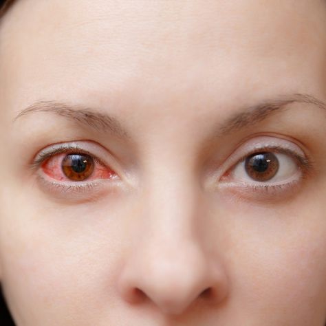 Close up of one annoyed red blood and health eye of female affected by conjunctivitis or after flu cold or allergy in... Red Eyes Remedy, Treating Pink Eye, Pink Eye Home Remedies, Pinkeye Remedies, Allergy Eyes, Cold Or Allergies, Eye Vitamins, Eye Infections, Watery Eyes