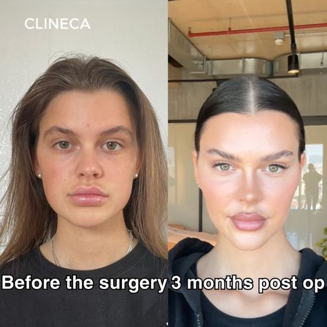 Can you guess what Nele got done? 👀 Swipe to see her stunning transformation! Hint: it’s all about the subtle details that make a big difference. 💫 Click on the picture to find out!

 #BeforeAndAfter #ClinecaTransformation #GlowUp #Transformation Upper Eyelid, Post Op, Glow Up?, Surgery, Then And Now, New Look, Thinking Of You, How To Find Out