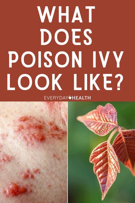 Poison ivy, the notorious cause of itchy, blistery rashes, grows throughout the continental United States and much of Canada. The plant can be found in forests and wetlands, on beaches, and along streams, as well as in urban settings such as parks, yards, and along roads. Poison ivy prefers partial sunlight, so it often grows where the land has been disturbed, such as along the edges of trails, fields, or landscaping. Home Remedy For Poison Ivy Rash, Oatmeal Bath For Poison Ivy, Poison Ivy Rash Pictures, Poison Oak Rash, Poison Ivy On Face, Poison Ivy Rash, Poison Ivy Remedies, Identify Poison Ivy, Itchy Rash