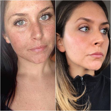 A woman on Reddit shared a before-and-after photo of her sun damage, four years apart. Find out the exact products she used to heal her sun damage. Natural Hair Treatments, Creme Anti Age, Sun Damaged Skin, Foaming Facial Cleanser, Glow Skin, Natural Moisturizer, Mario Badescu, Sun Damage, Anti Aging Cream