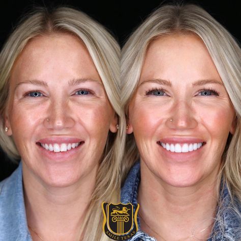 Veneers Before And After, Dental Esthetics, Teeth Transformation, Virtual Consultation, Teeth Remedies, Teeth Whitening Methods, Teeth Implants, Perfect Teeth, Nice Teeth