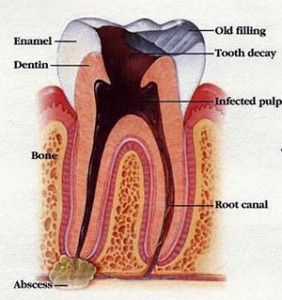 » How to Relieve Throbbing Tooth Pain Natural Allergy Relief, Dental Infection, Tooth Ache Relief, Tooth Infection, Tooth Pain, Gum Care, Dental Procedures, Root Canal, Tooth Decay