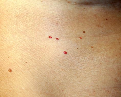 7 Reasons Your Skin Has Red Spots and Bumps Red Spots On Face, Red Skin Spots, Red Freckles, Red Moles, Remove Skin Tags Naturally, Home Remedies For Skin, Skin Moles, Heat Rash, Skin Rashes