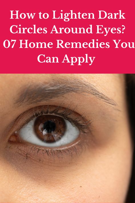 How to Lighten Dark Circles Around Eyes? 07 Home Remedies You Can Apply Black Undereye, Aging Skin Remedies, Eyes Dark Circles, Dark Circles Around Eyes, Sunken Eyes, Natural Bleach, Dark Eye Circles, Eyes Dark, How To Get Rid Of Pimples