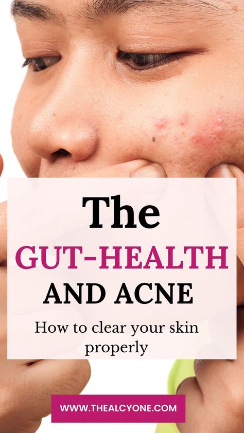 Back Acne Remedies, Acne Diet, Forehead Acne, Gut Health Diet, Skin Detox, Hormonal Acne, Acne Remedies, Health Skin Care, How To Get Rid Of Acne