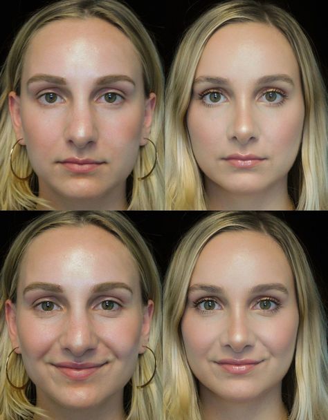 Your Guide to Rhinoplasty, From Cost to Recovery Time | Life in Plastic Jaw Reduction Surgery, Nose Plastic Surgery, Nose Surgery Rhinoplasty, Bulbous Nose, Plastic Surgery Fail, Rhinoplasty Nose Jobs, Plastic Surgery Gone Wrong, Rhinoplasty Before And After, Face Surgery