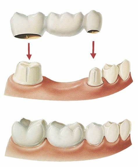 Dental Bridge Cost, Dental Posters, Bridge House, Dental Videos, Dental Facts, Teeth Implants, Teeth Shape, Dental Bridge, Dental Veneers