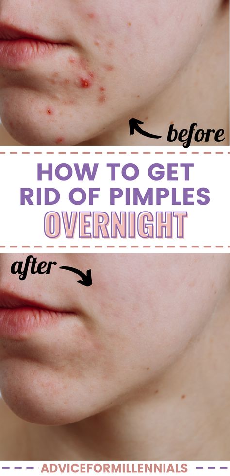 How to get rid of pimples overnight Overnight Pimple Remedies, Pimple Remedies, Dry Out Pimples, Zit Remedy, Huge Pimple, Rid Of Pimples Overnight, Big Pimple, Back Acne Remedies, Blind Pimple