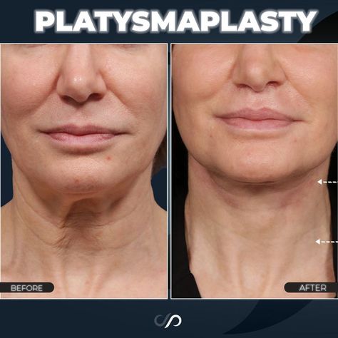 Neck Lift Before And After, Lower Face Lift Before And After, Neck Rejuvenation, Lower Face Lift, Thread Lift Face, Neck Lift Surgery, Saggy Neck, Face Lift Surgery, Facial Surgery