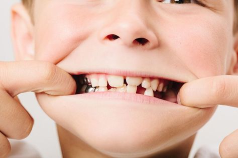 The term silver tooth kid refers to kids that get silver caps placed on their decaying baby teeth. However, it can also allude to a meme that describes a 'bad' kid. #parenting #parents Baby Teeth Jewelry, Due Date Calculator, Silver Tooth, Bad Kid, Toddler Gear, Kids Teeth, Amazon Prime Day Deals, Teeth Jewelry, Real Moms