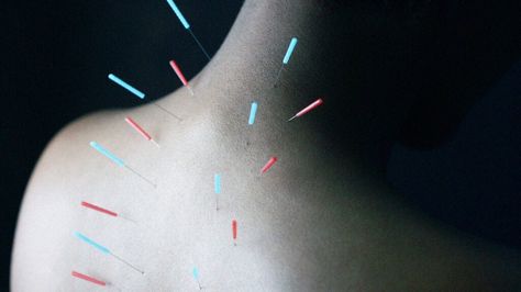 Acupuncture for neck pain: Does it work? Therapeutic Yoga, Black Skin Care, Upper Back Pain, Professional Massage, Harvard Medical School, Homemade Face, Chinese Medicine, Acupressure, Neck Pain