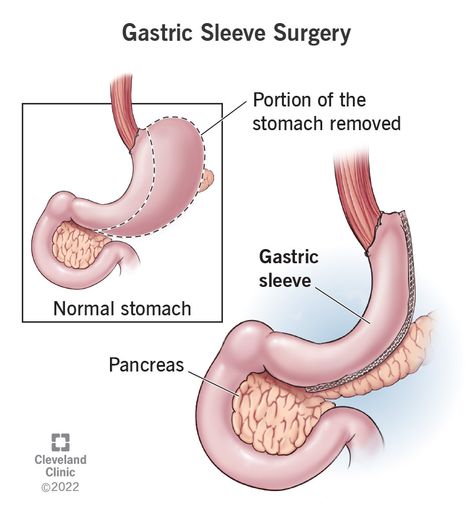 Gastric Sleeve Surgery: What it Is, Requirements Sleeve Operation, Sleeve Gastrectomy, Sleeve Surgery, General Surgery, Liquid Diet, Health Screening, Cleveland Clinic, After Surgery, Health Articles