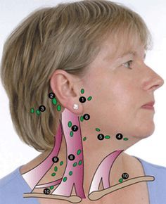 Example of Lymph Nodes in Head and Neck Clinical Nurse Specialist, Lymph Glands, Abnormal Cells, Lymph Fluid, Slim People, Lymph Massage, Lymph System, Squamous Cell, Lymph Drainage