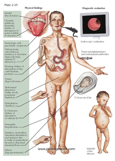 Celiac Disease Celiac disease, also known as gluten-sensitive enteropathy or nontropical sprue, is a chronic immune-mediated enteropathy triggered by Gi Anatomy, Med School Study, Medical Notes, Coeliac Disease, Integumentary System, Nursing Study Guide, Chronic Constipation, Nurse Study Notes, Nursing Student Tips