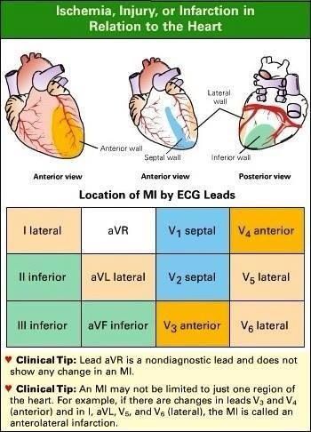 Electrocardiogram interpretation skills made simple. Locating acute STEMI or MI-line up this diagram with a 12 Lead #STEMI #ACS #ECG #EKG Cardiology Nursing, Paramedic School, Nursing Mnemonics, Medical Student Study, Medical Surgical Nursing, Cardiac Nursing, Nursing School Survival, Critical Care Nursing, Nursing School Studying