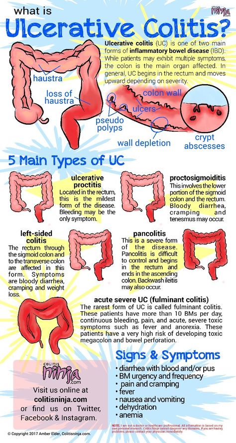 Ulcerative Colitis Gastrointestinal Nursing, Nursing Mnemonics, Nursing School Survival, Nursing School Studying, Nursing School Tips, Medical School Studying, Nursing School Notes, Nursing Tips, Nursing Study