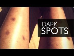 HOW TO GET RID OF DARK SPOTS ON LEGS & BODY FAST | GET CLEAR EVEN SKIN TONE ALL OVER! - YouTube Black Spots On Legs Remove, Hyperpigmentation On Legs Dark Spots, How To Get Rid Of Dark Spots On Legs Diy, Black Spots On Face Remove Fast, How To Get Rid Of Scars On Legs Diy, How To Get Rid Of Mosquito Bites Fast, How To Remove Scars On Legs Fast, Autoimmune Symptoms, Clear Even Skin